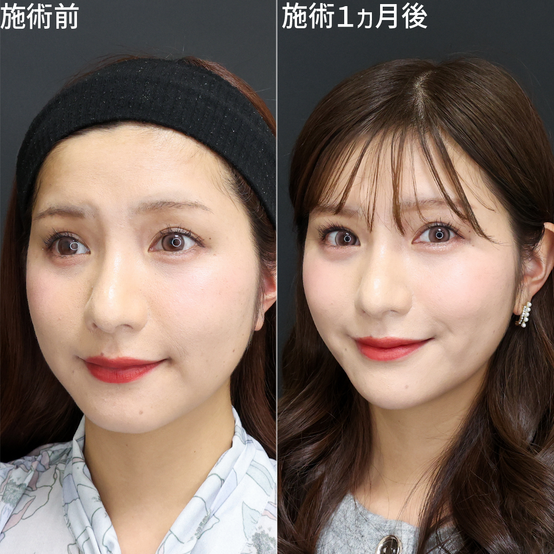 元NMB48谷川愛梨さんご来院！卵型フェイスラインに♡