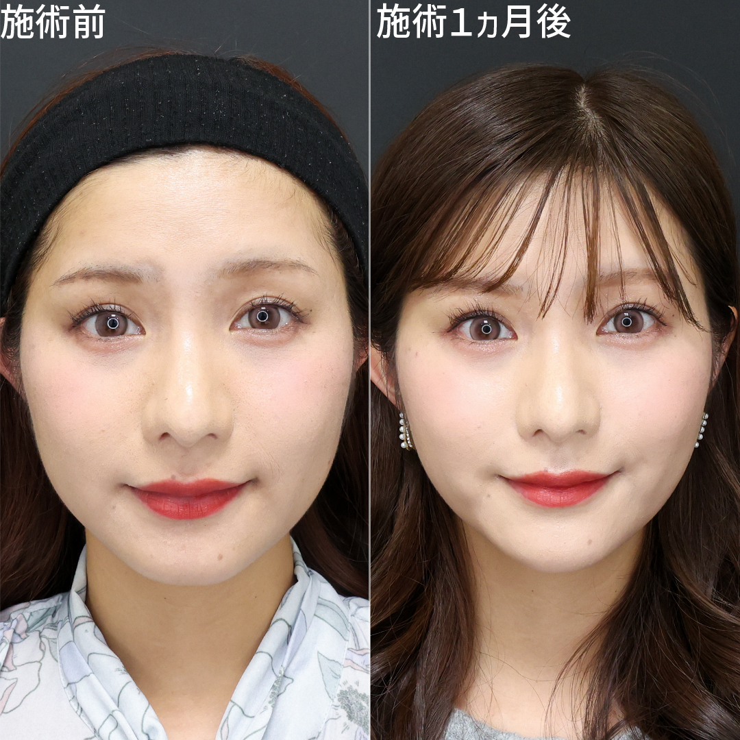 小顔整形｜パーフェクトフェイスライン/ジョールファット除去/TAC式 ツヤ肌コラーゲンリフト®の症例写真 施術前後 