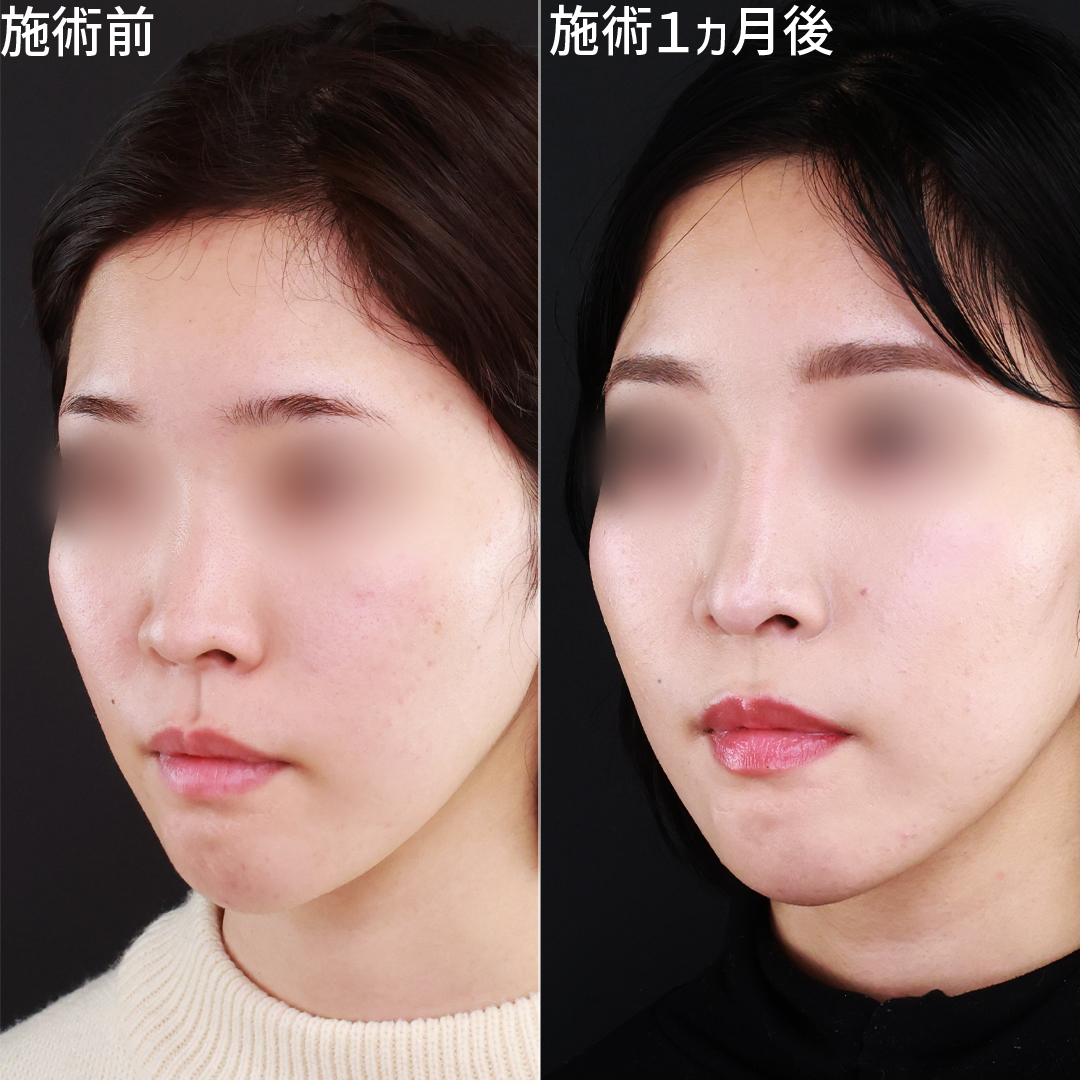 Dr.もりもりの鼻整形！自然で綺麗な鼻筋と鼻先に