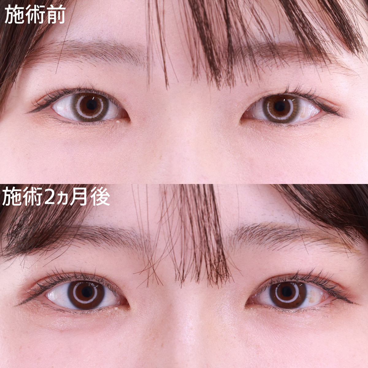 【二重埋没法】元々の二重の形は変えずに幅を広げてぱっちりとした目元に