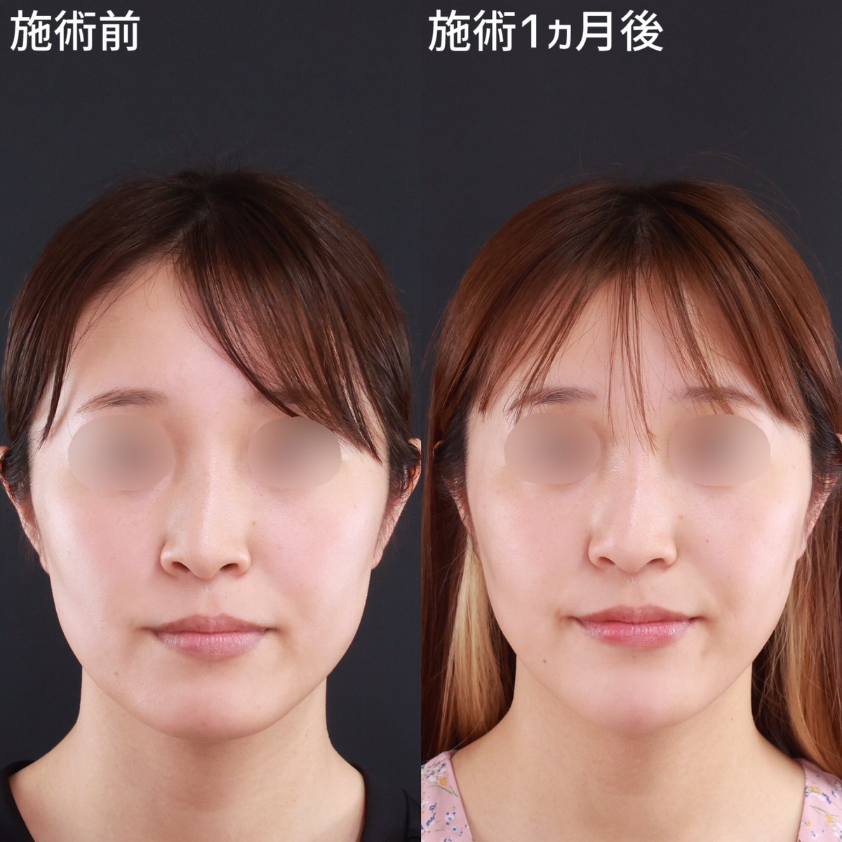 【小顔整形】口周りのもたつきを撃退し、理想のたまご型の輪郭へ