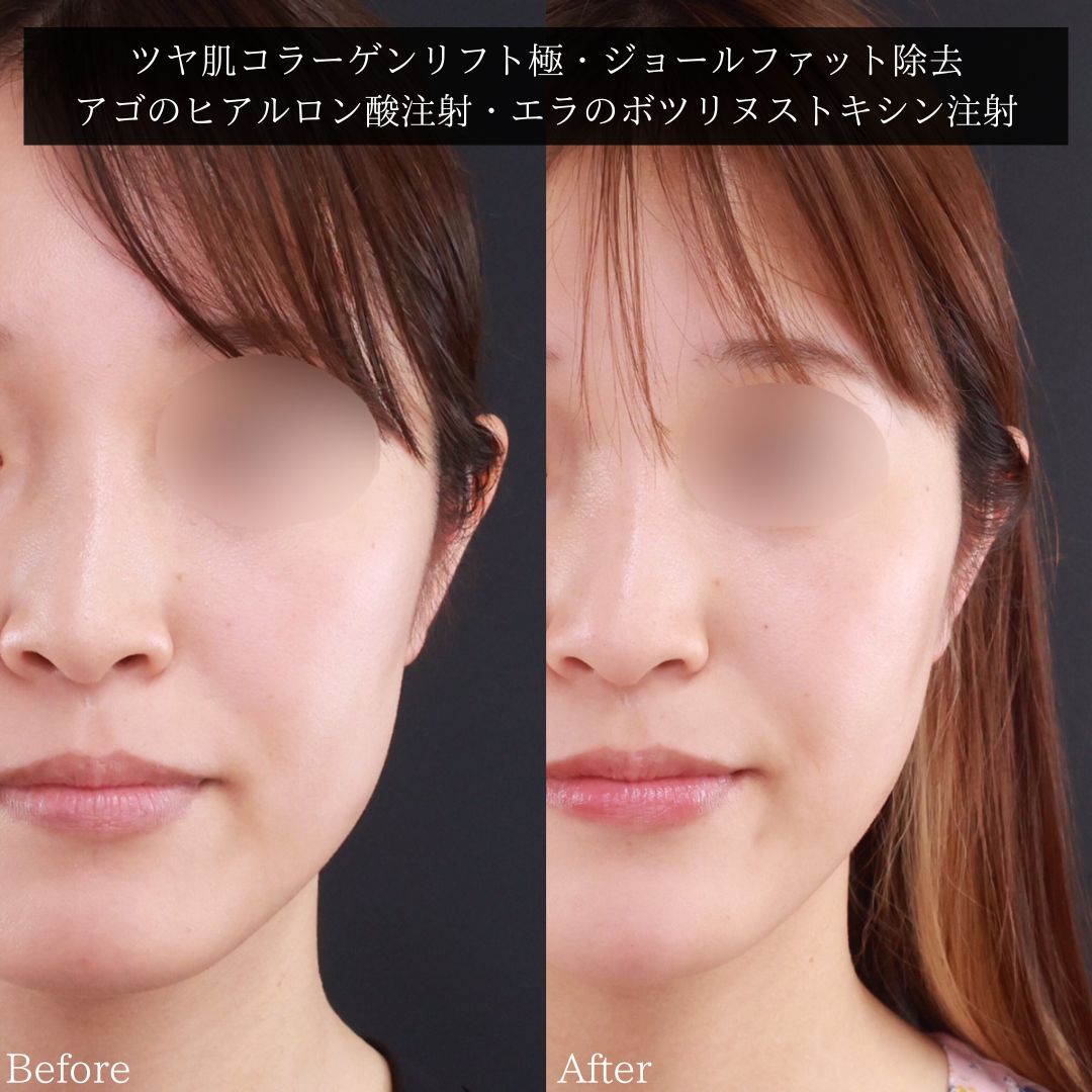 TAC式 ツヤ肌コラーゲンリフト®/ジョールファット除去/エラボトックス注射の症例写真 施術前後 