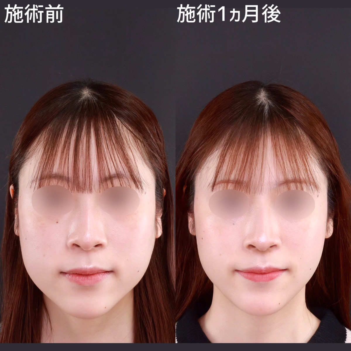 【小顔整形】お顔の余白をなくし垢抜けた印象へ