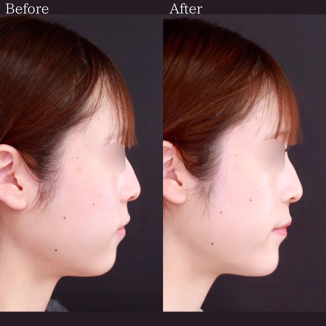 TAC式 ツヤ肌コラーゲンリフト®/エラボトックス注射/顎のヒアルロン酸注射の症例写真 施術前後 