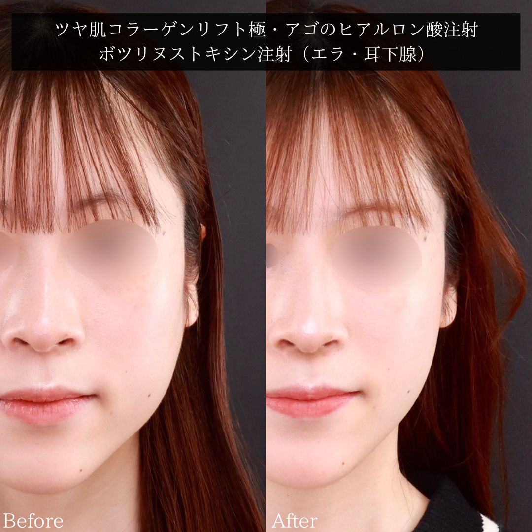 TAC式 ツヤ肌コラーゲンリフト®/エラボトックス注射/顎のヒアルロン酸注射の症例写真 施術前後 