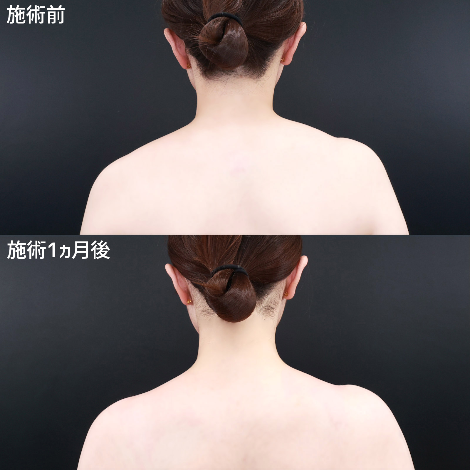 首･肩ボトックス注射の症例写真 施術前後 