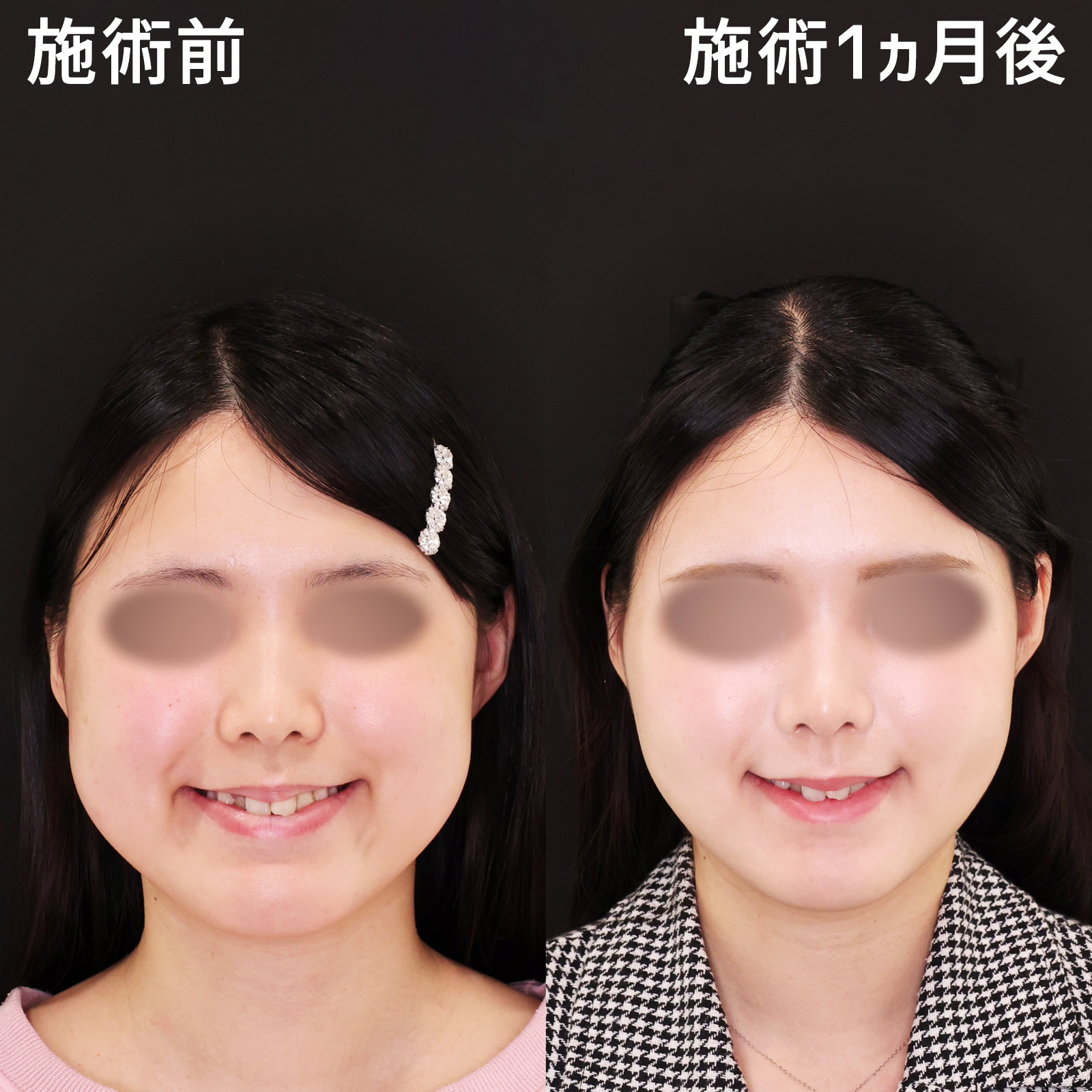 TAC式 ツヤ肌コラーゲンリフト®/バッカルファット除去/エラボトックス注射の症例写真 施術前後