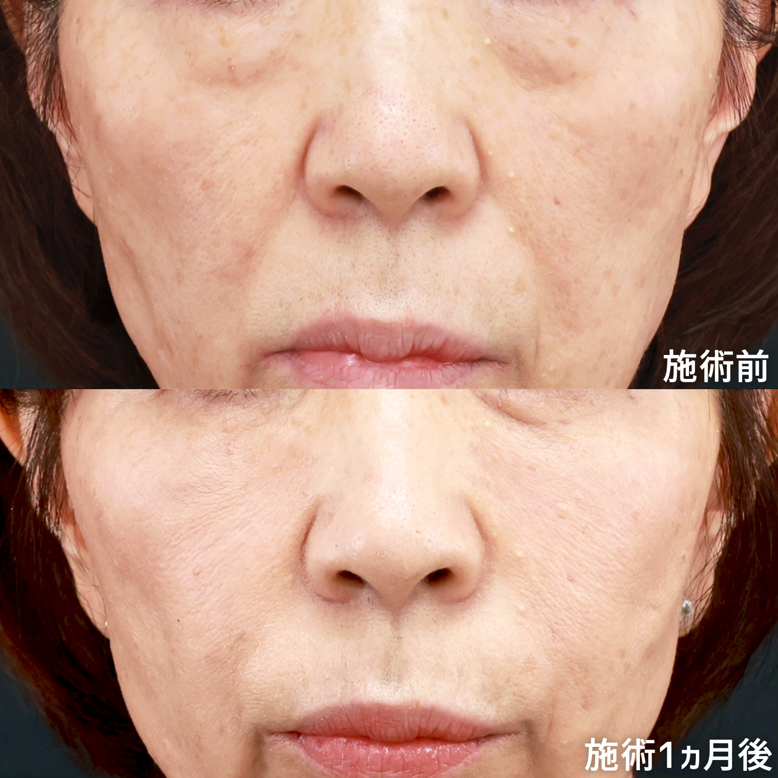 下眼瞼脱脂術(目の下のたるみ取り・目の下の脂肪ふくらみ取り)/顔の脂肪注入(コンデンスリッチフェイス)の症例写真 施術前後