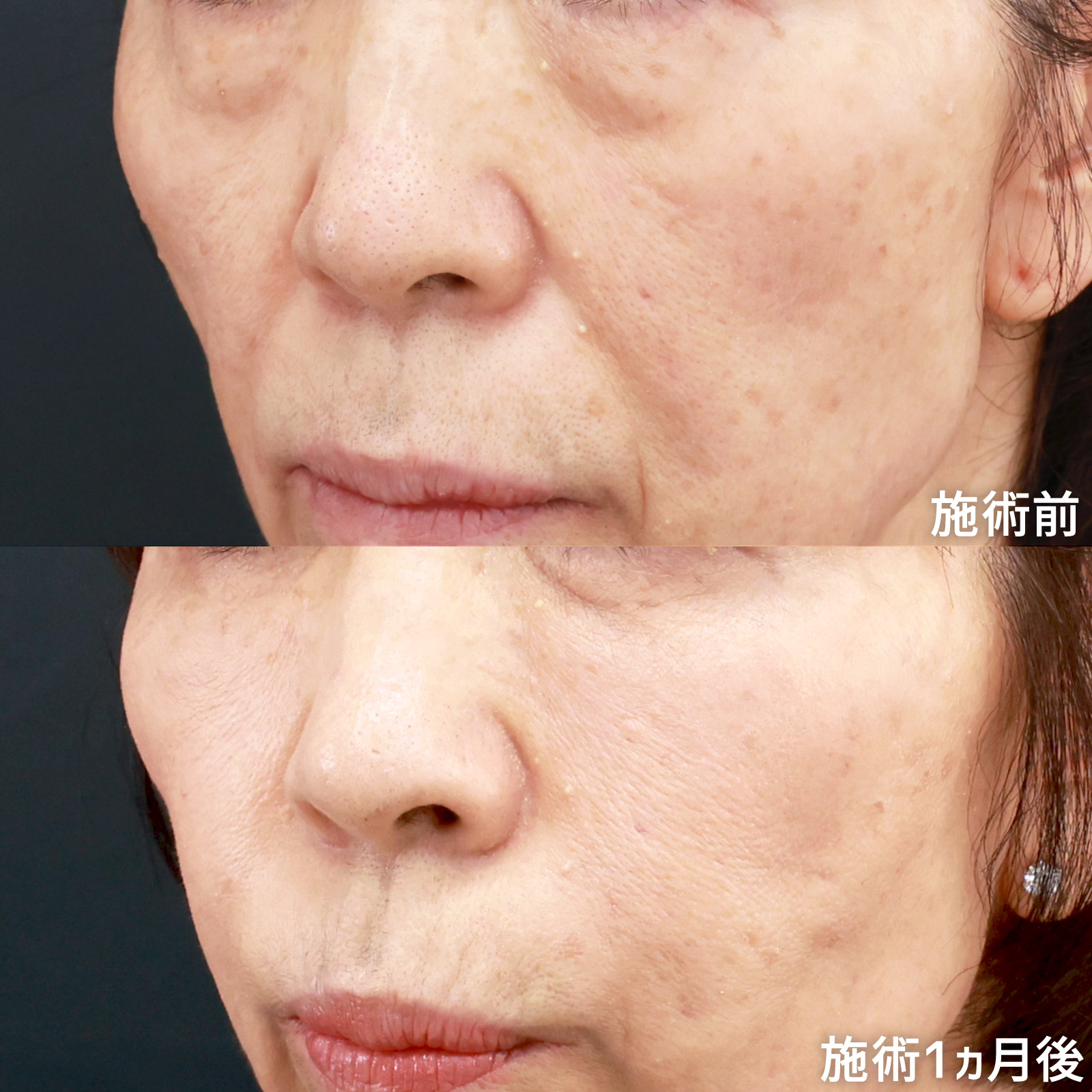 下眼瞼脱脂術(目の下のたるみ取り・目の下の脂肪ふくらみ取り)/顔の脂肪注入(コンデンスリッチフェイス)の症例写真 施術前後