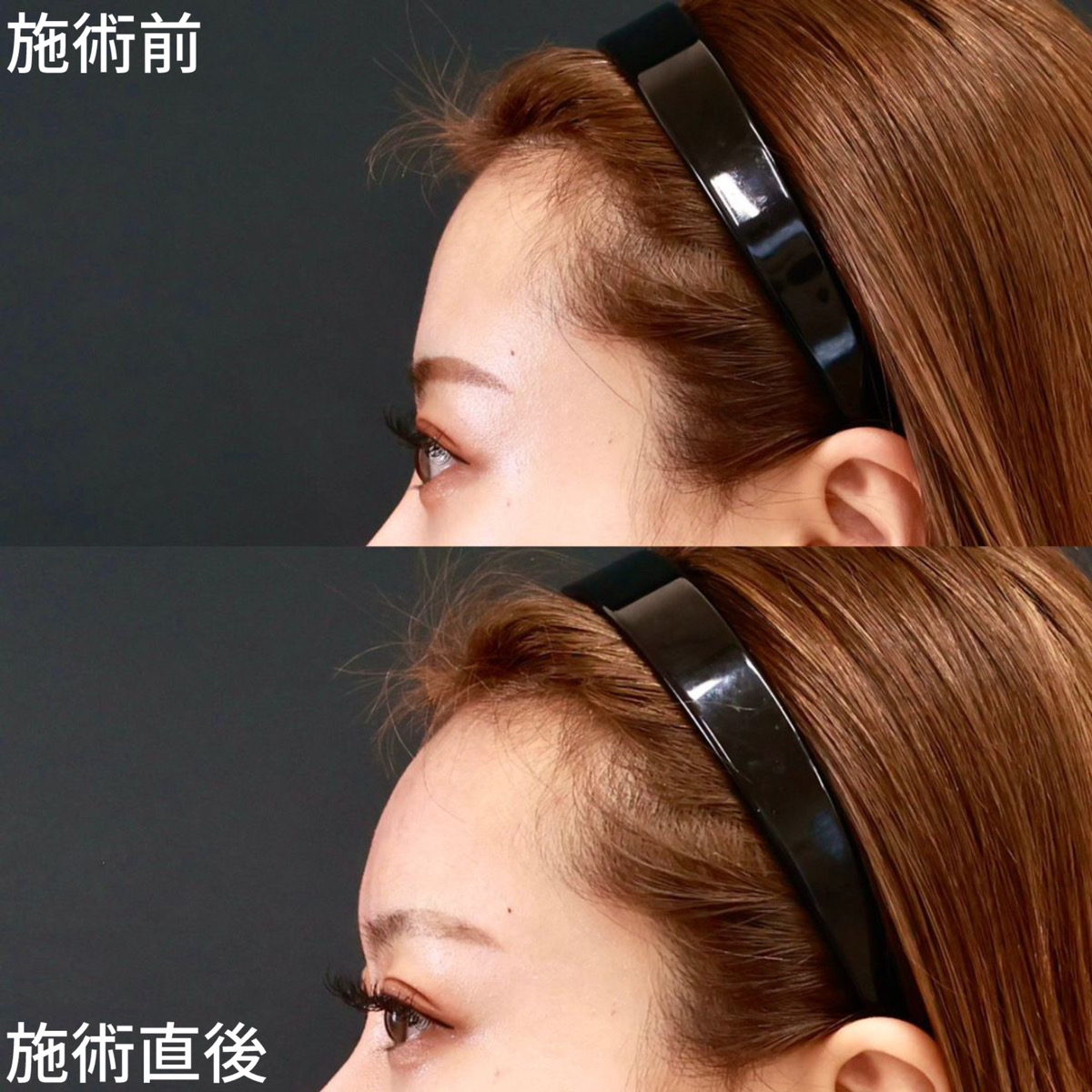 おでこ・こめかみのヒアルロン酸注射の症例写真 施術前後 