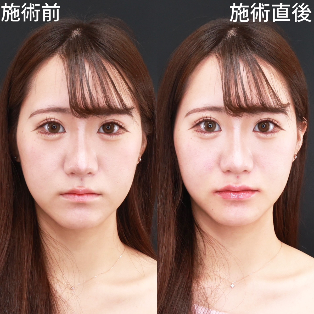の症例写真 施術前後