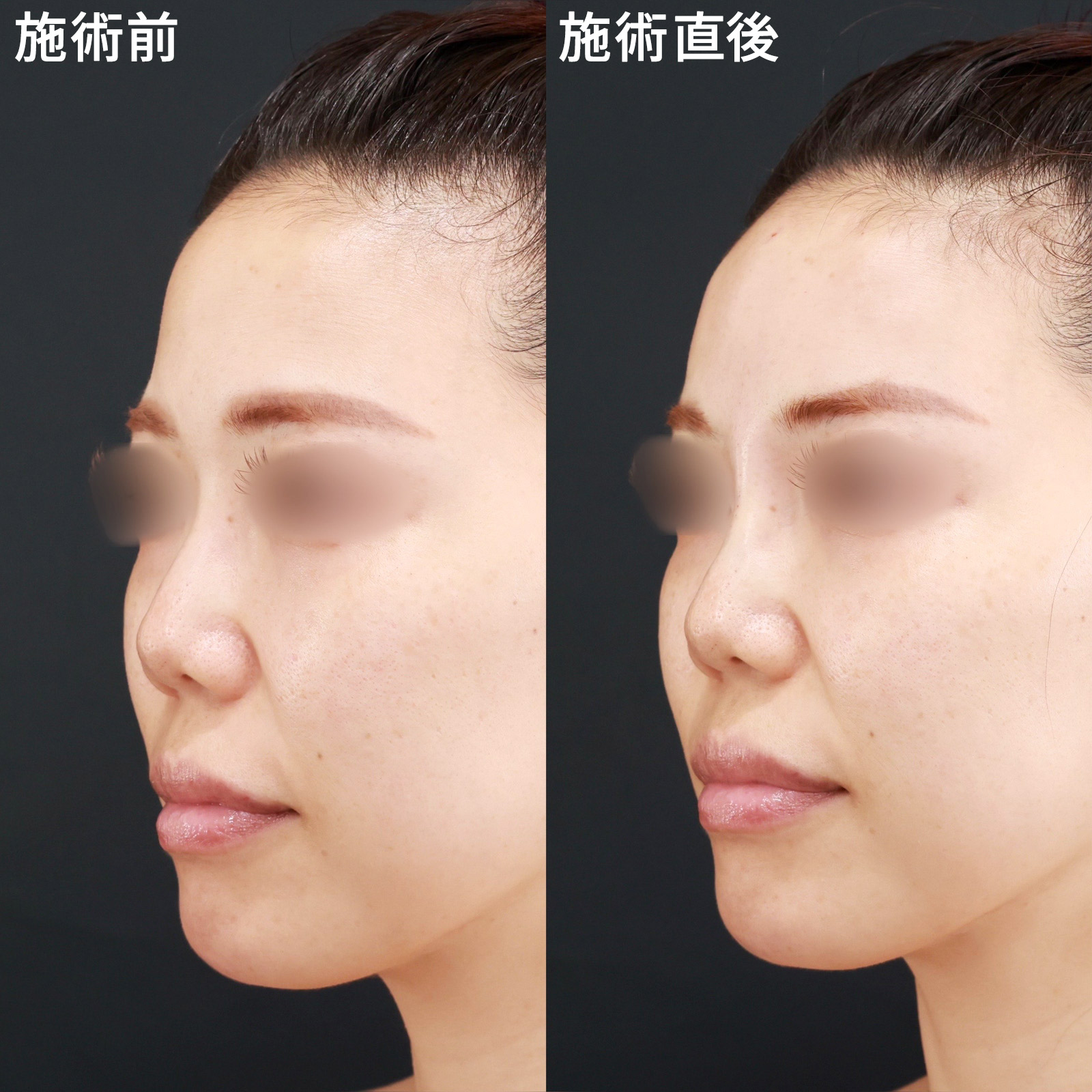 おでこ・こめかみのヒアルロン酸注射/鼻のヒアルロン酸注射の症例写真 施術前後