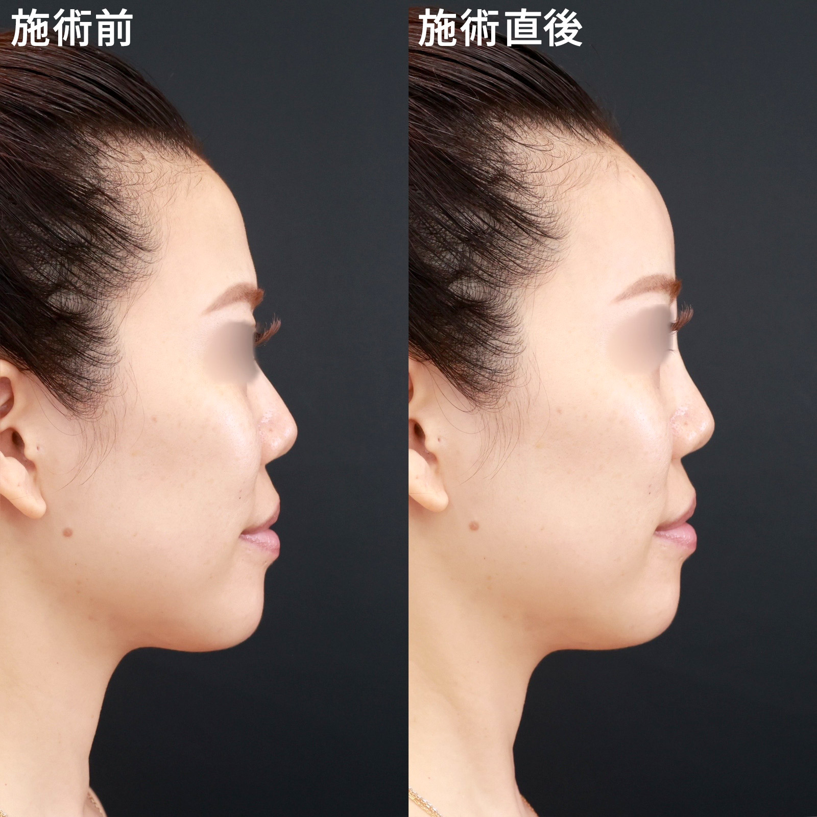 【おでこヒアルロン酸】たった1日で凹みを解消！丸いおでこで洗練された横顔に