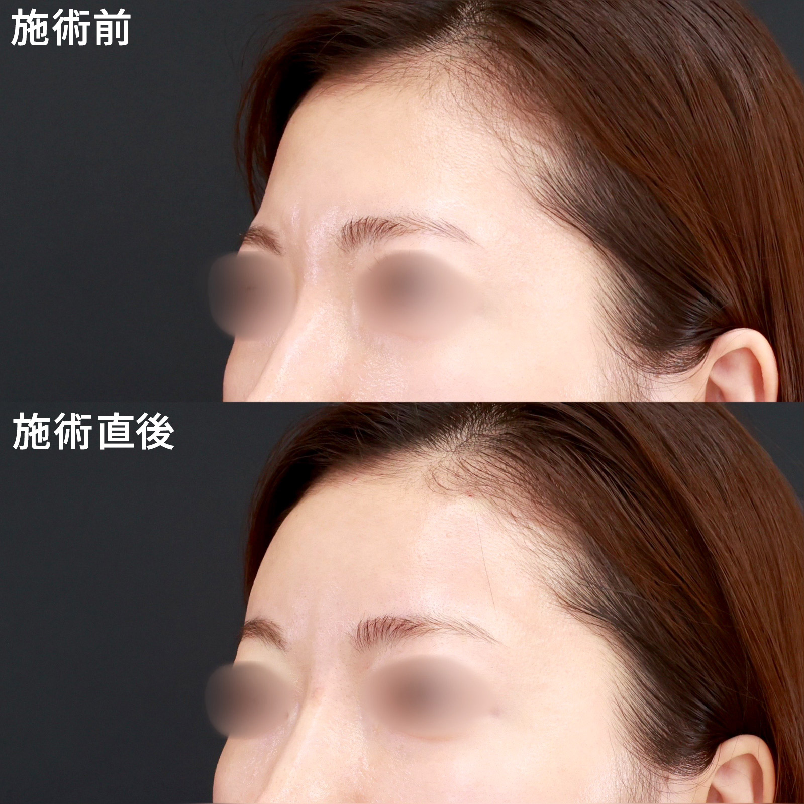 【おでこヒアルロン酸】ダウンタイムほぼなし！たった数分で立体感のある丸いおでこに