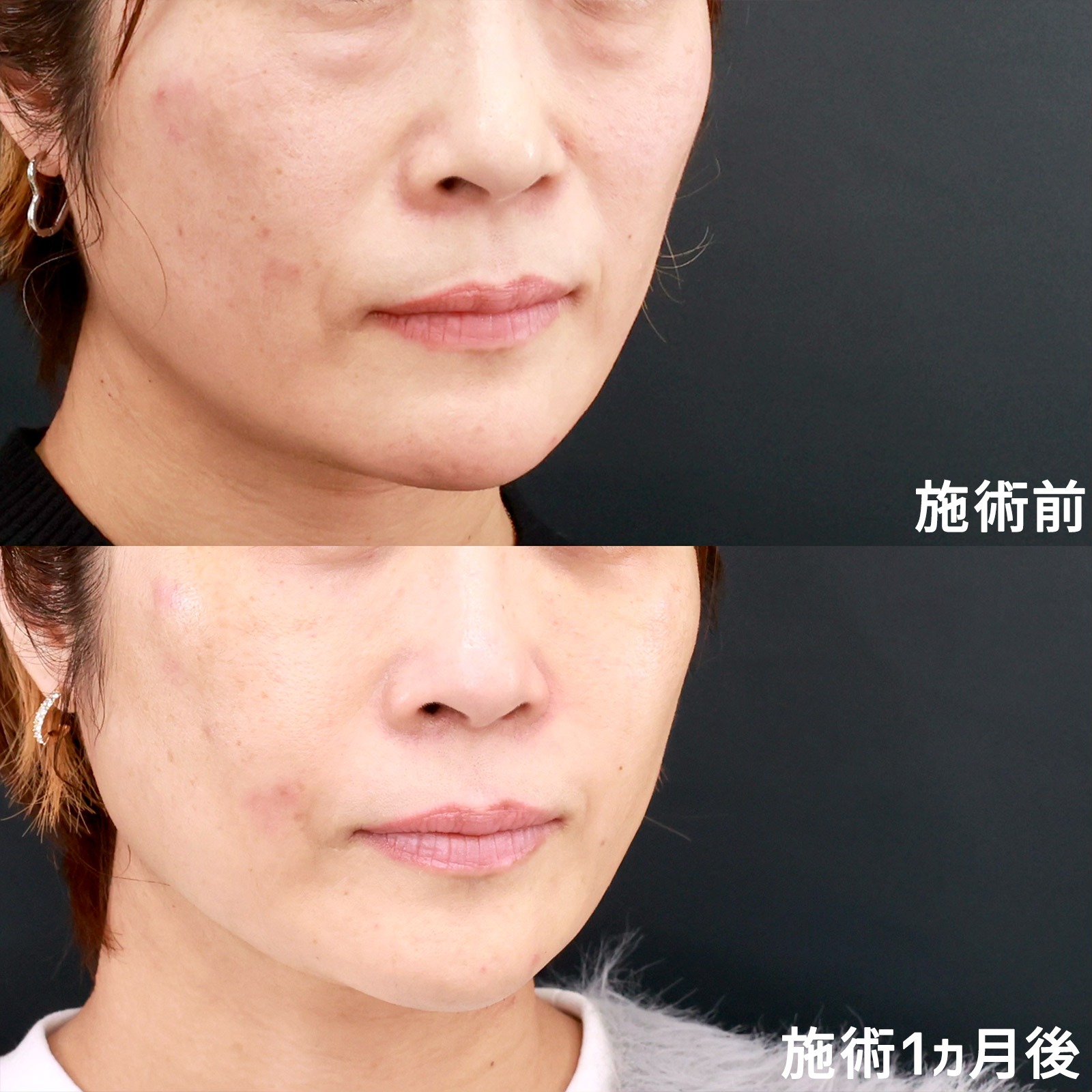 顔の脂肪注入(コンデンスリッチフェイス)/下眼瞼脱脂術（目の下のたるみ取り・目の下の脂肪ふくらみ取り）の症例写真 施術前後 