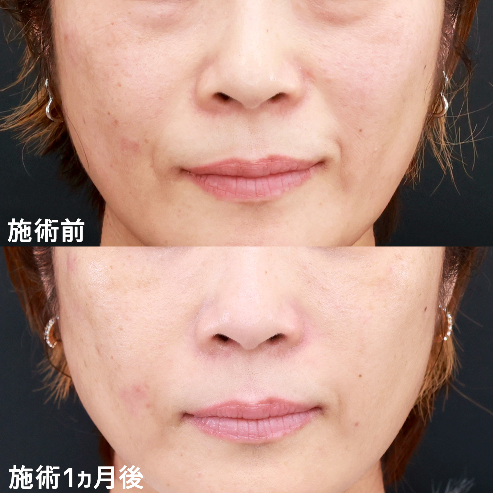 【コンデンスリッチ脂肪注入】年齢を感じさせる中顔面のアンチエイジング