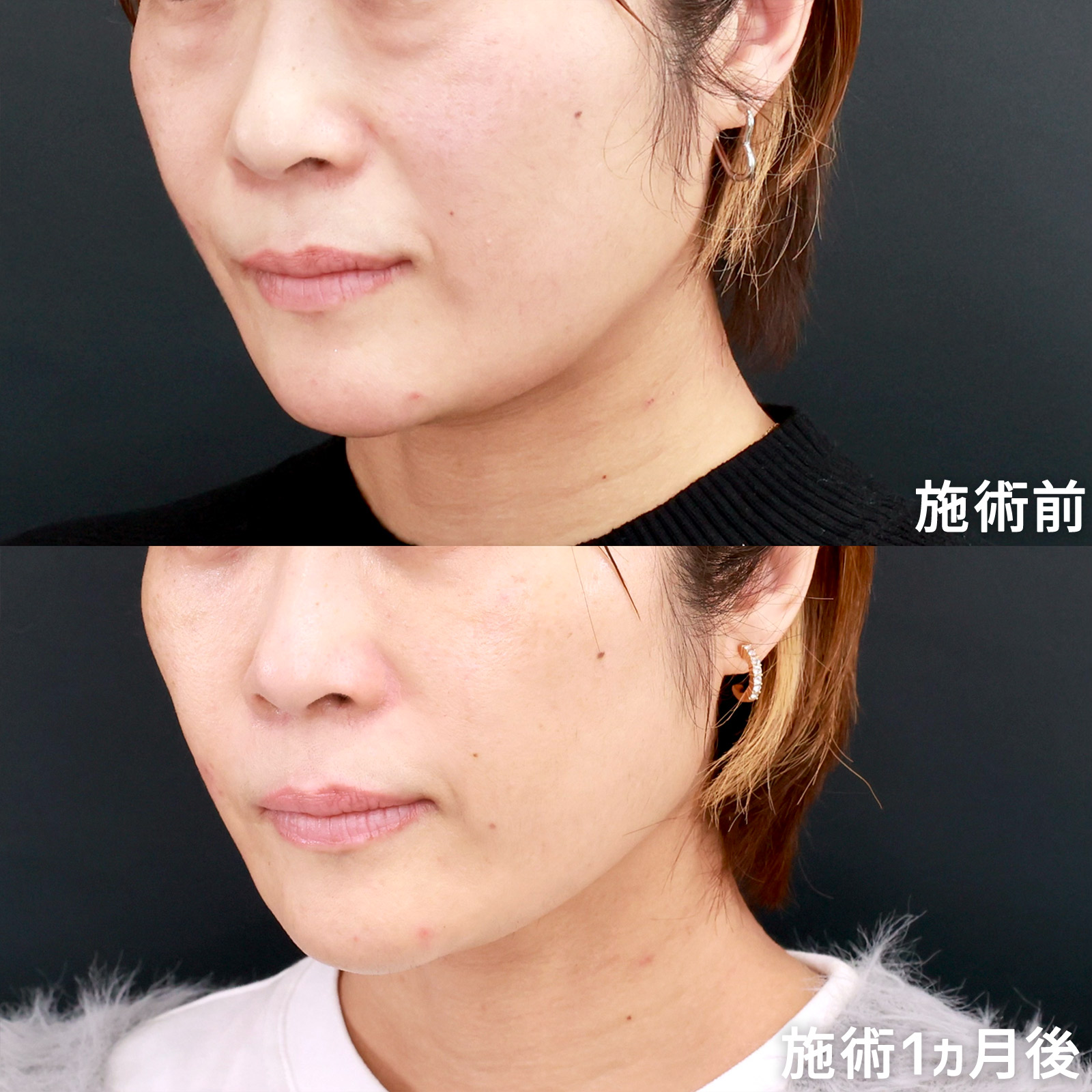 顔の脂肪注入(コンデンスリッチフェイス)/下眼瞼脱脂術（目の下のたるみ取り・目の下の脂肪ふくらみ取り）の症例写真 施術前後 