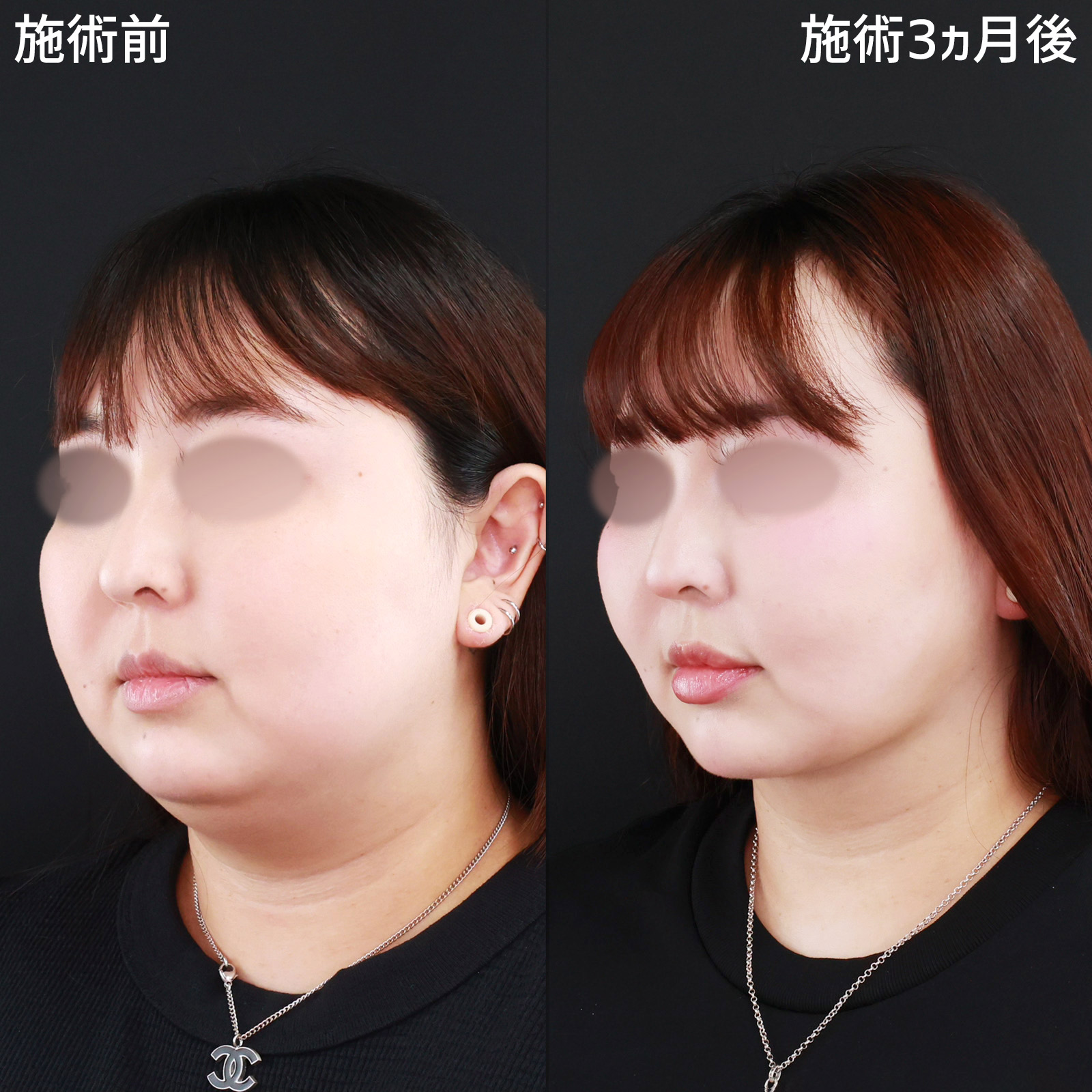 【別人級の小顔術】脂肪吸引で二重顎を解消！美しいフェイスラインが出現