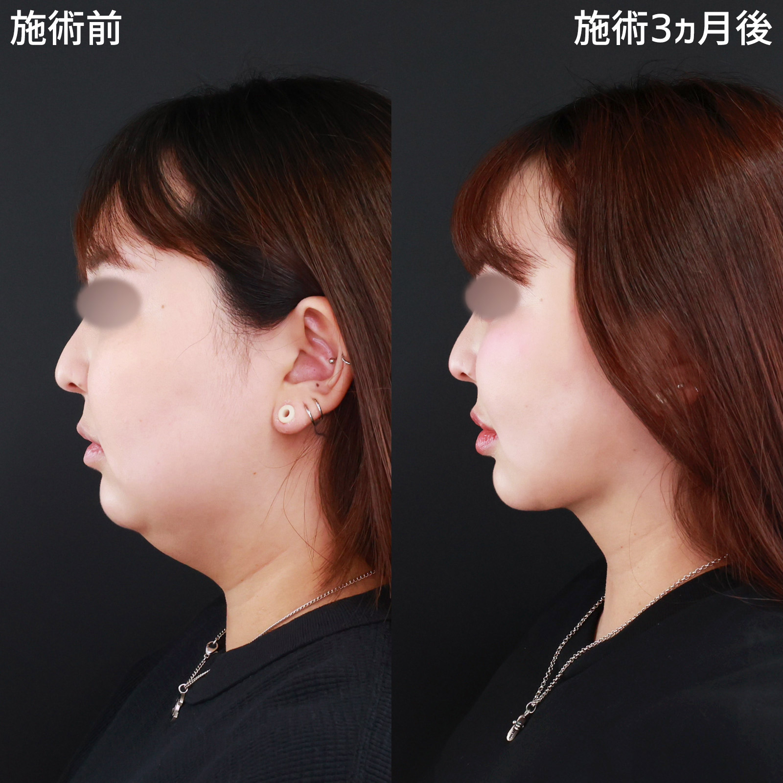 TAC式 ツヤ肌コラーゲンリフト®/バッカルファット除去/ジョールファット除去の症例写真 施術前後