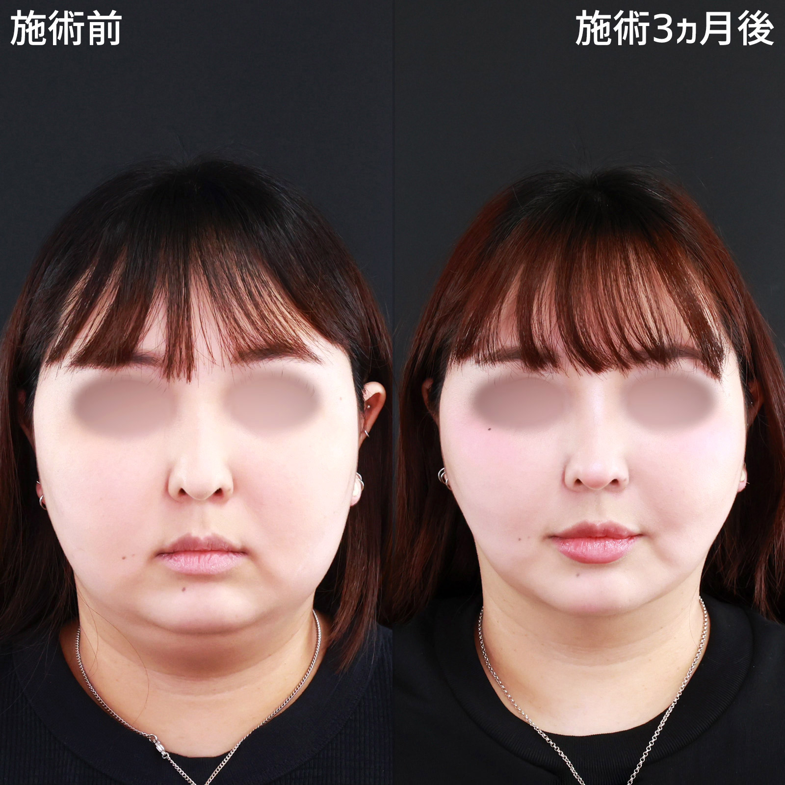 TAC式 ツヤ肌コラーゲンリフト®/バッカルファット除去/ジョールファット除去の症例写真 施術前後