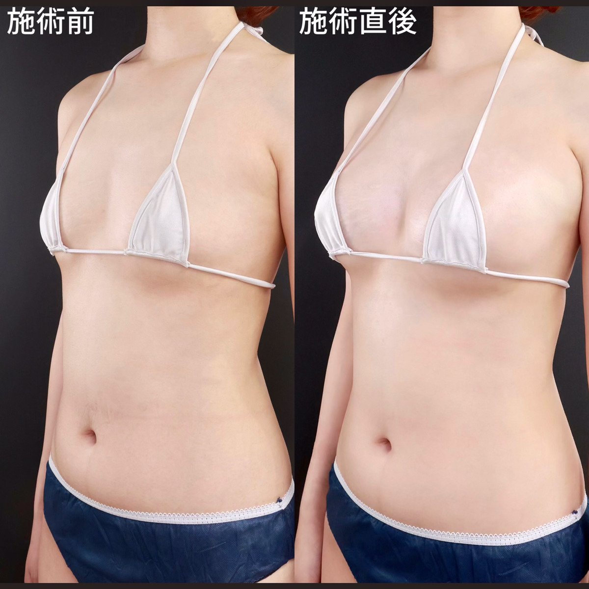 【ヒアルロン酸豊胸】施術直後から美バスト!理想のカップ数に!