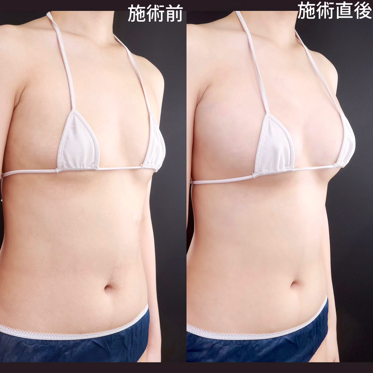 ヒアルロン酸注入豊胸術(グラビアバスト)の症例写真 施術前後