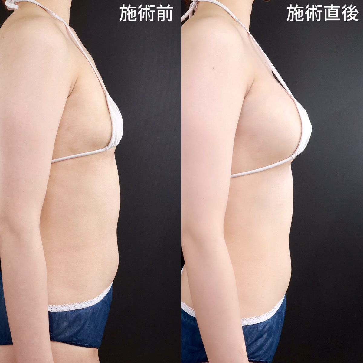 ヒアルロン酸注入豊胸術(グラビアバスト)の症例写真 施術前後
