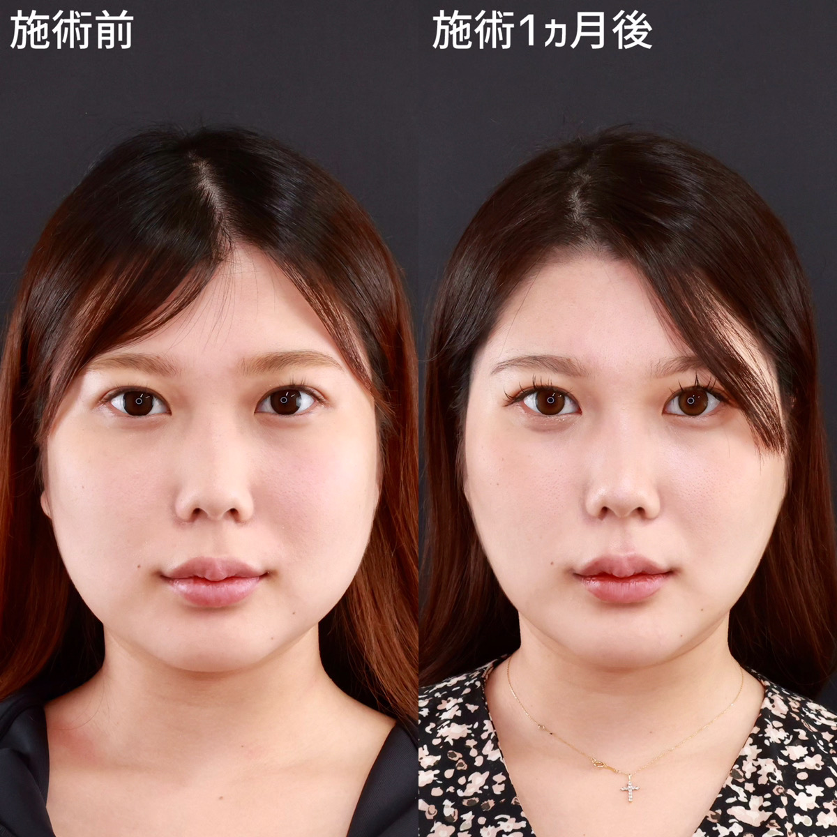 TAC式 ツヤ肌コラーゲンリフト®/顔の脂肪吸引/バッカルファット除去の症例写真 施術前後