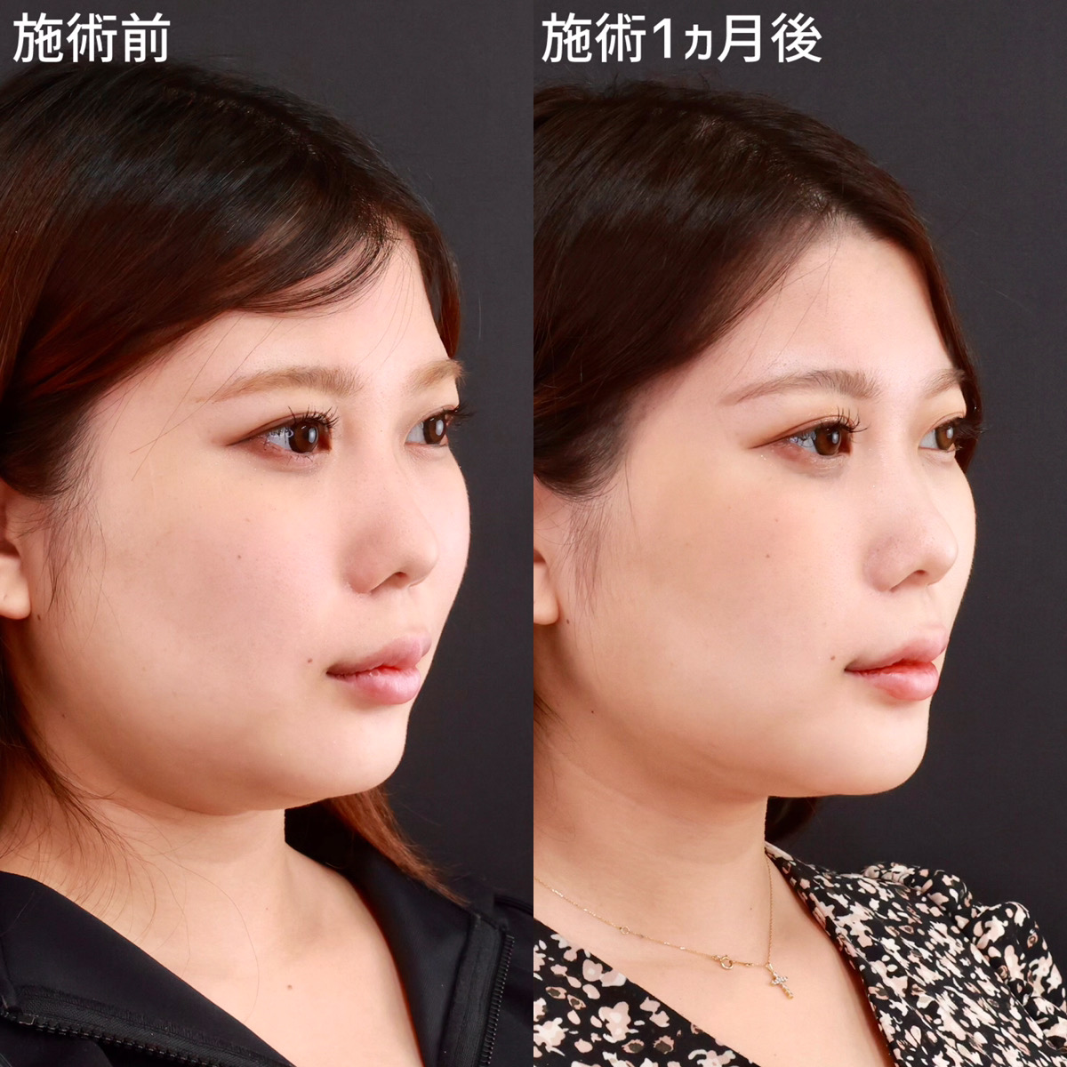 TAC式 ツヤ肌コラーゲンリフト®/顔の脂肪吸引/バッカルファット除去の症例写真 施術前後