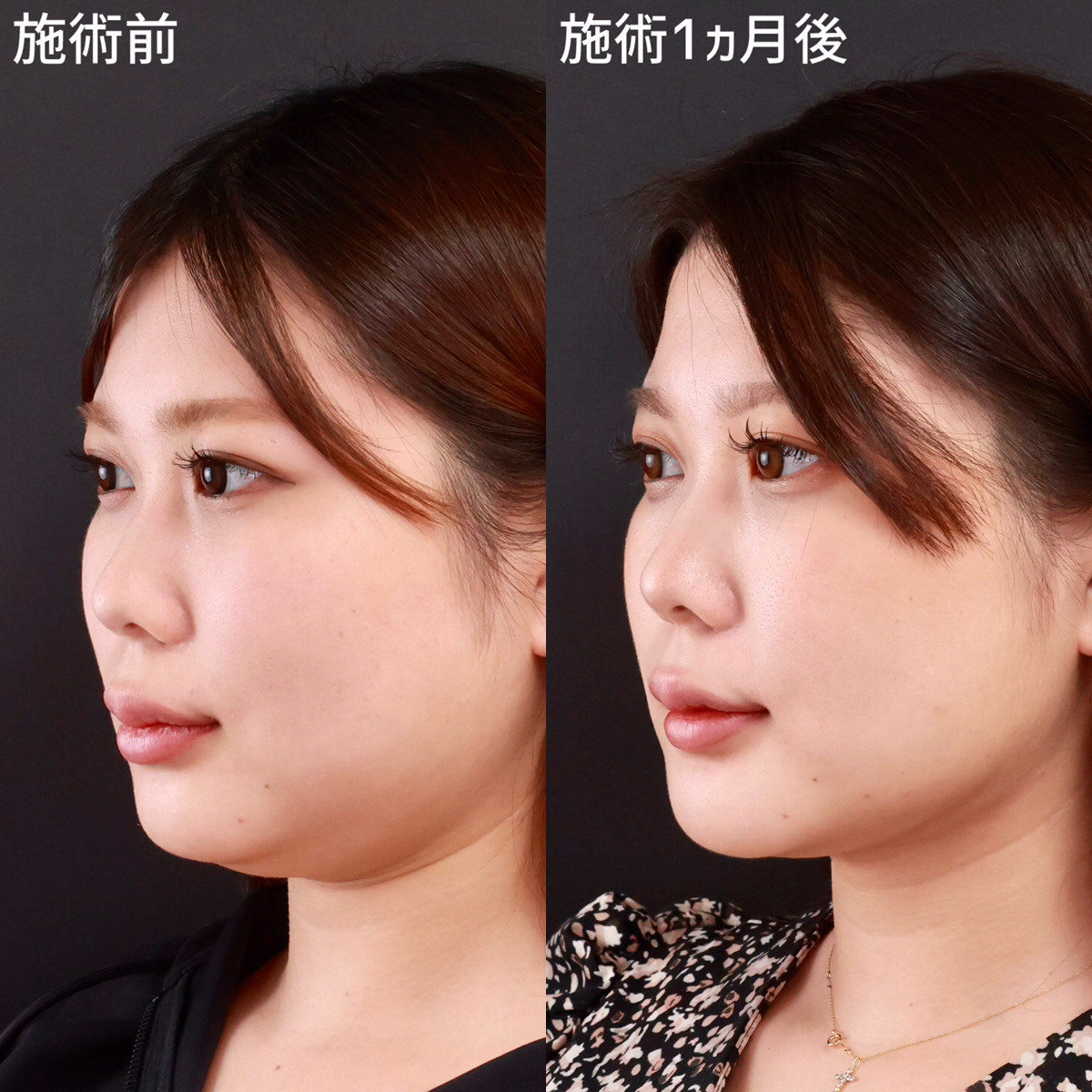 【小顔整形】二重アゴを撃退！美しいフェイスラインに！