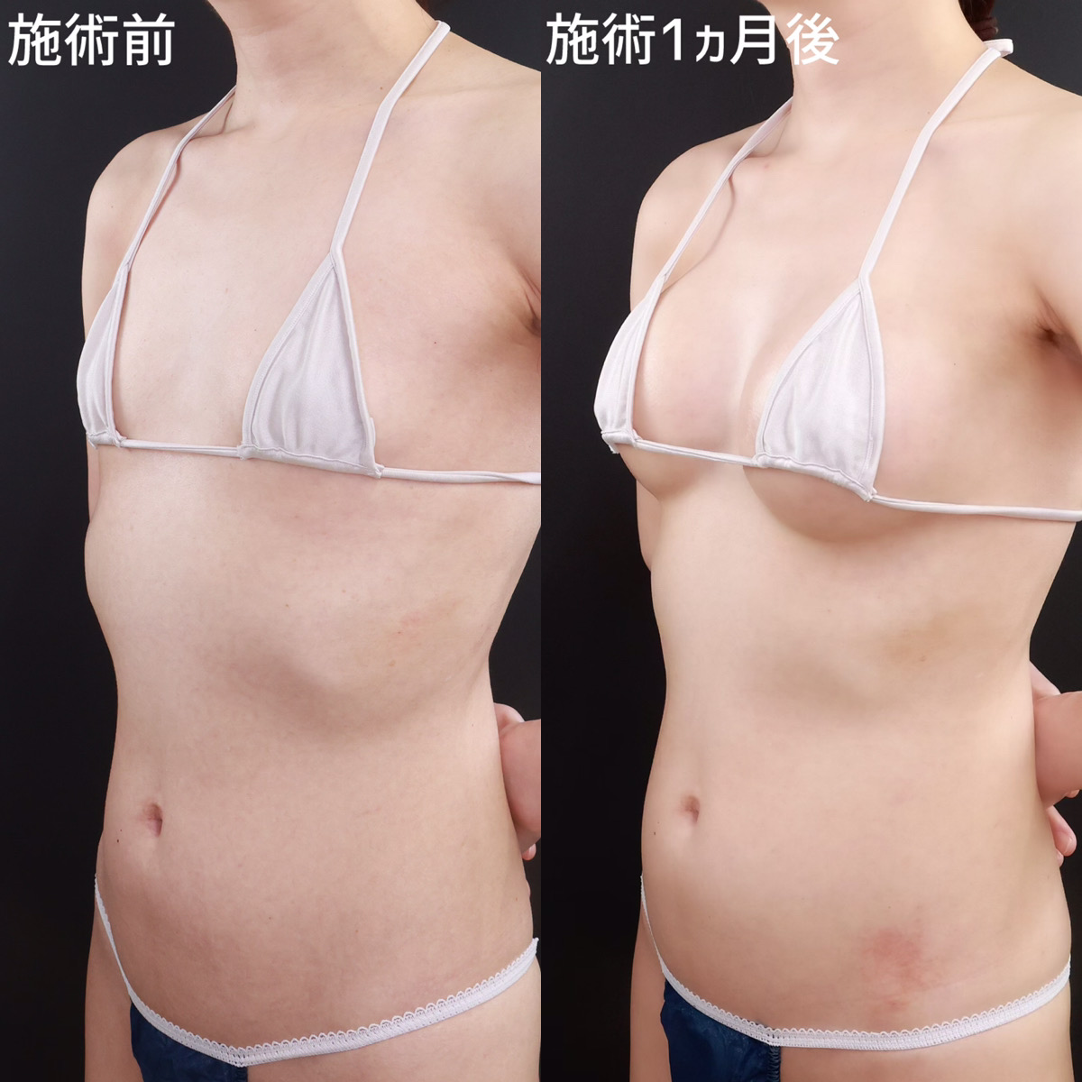 シリコンバッグ豊胸（人工乳腺バッグ）の症例写真 施術前後 