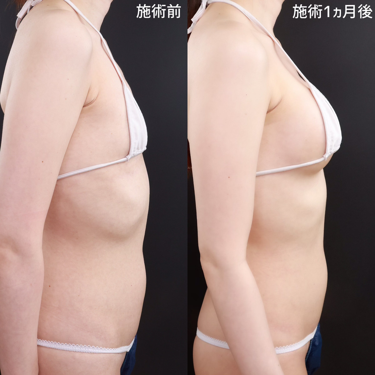 シリコンバッグ豊胸（人工乳腺バッグ）の症例写真 施術前後 