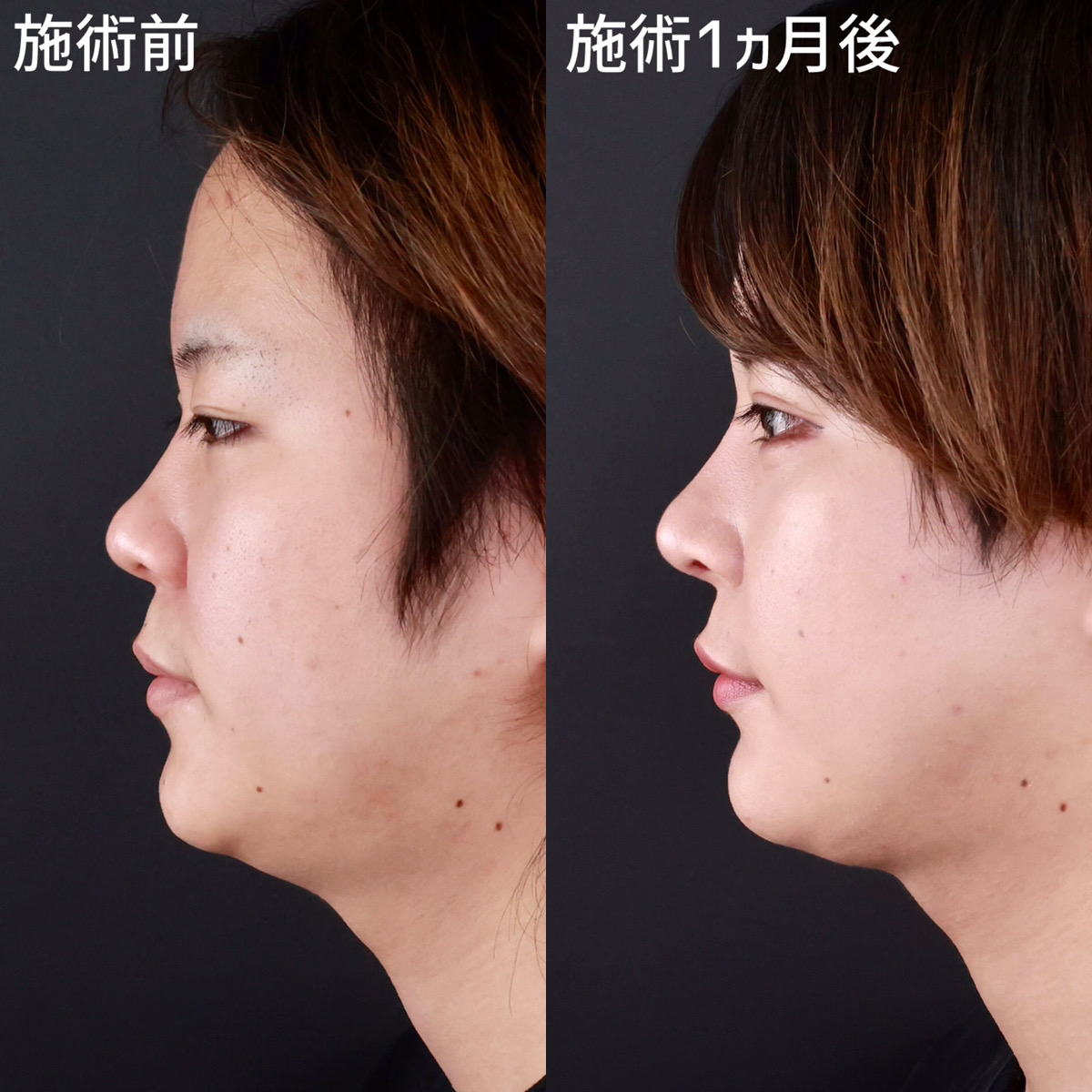 二重埋没法/目尻切開術/目尻靭帯移動術の症例写真 施術前後 