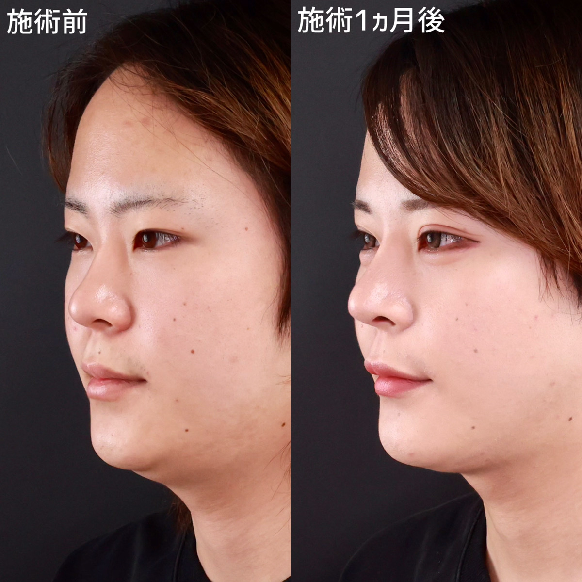 ふじた式整体科学 刻まれた不調の痕跡 瘢痕修正 | TETSU形成・美容クリニック 田中哲一郎のブログ