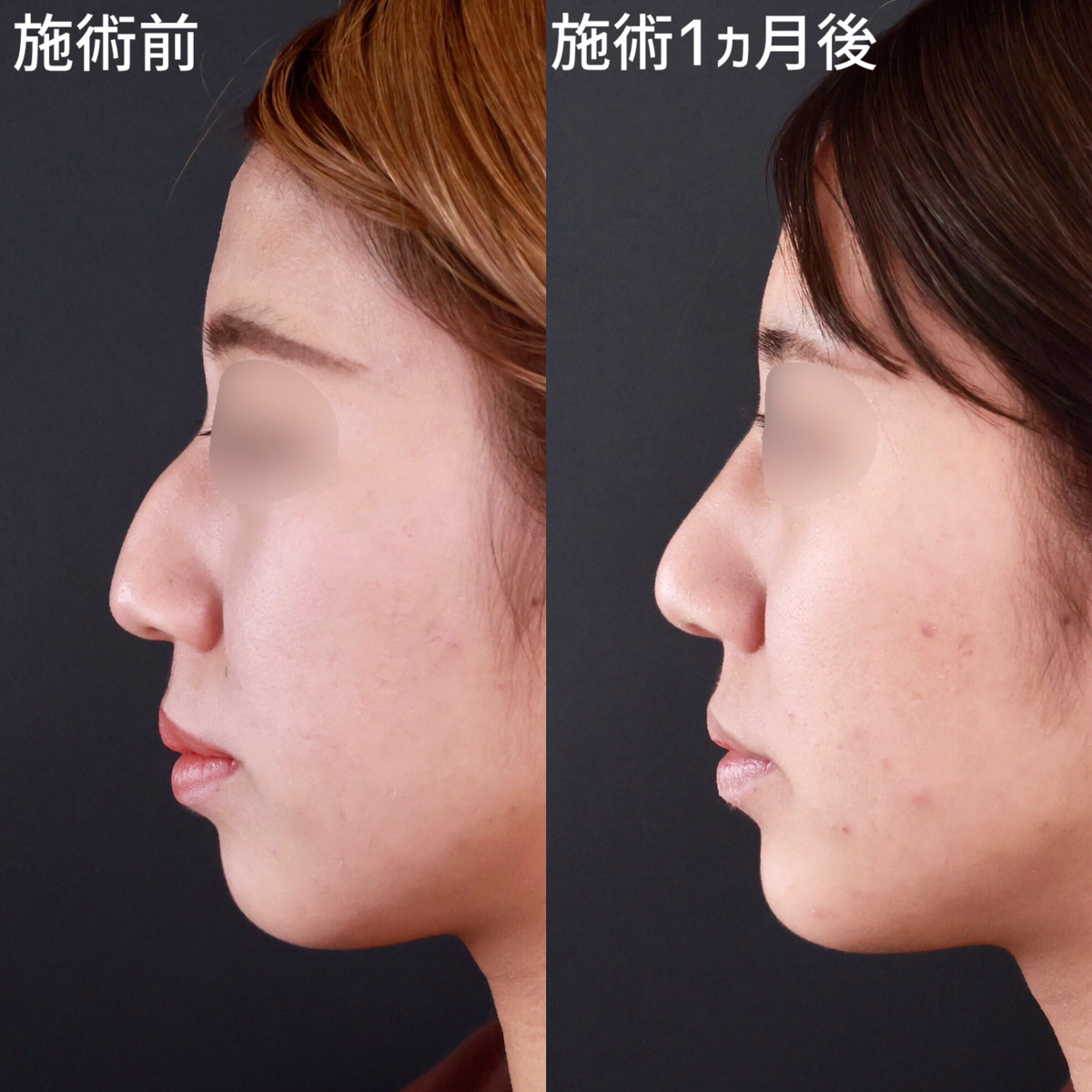鼻：その他の症例写真 施術前後 
