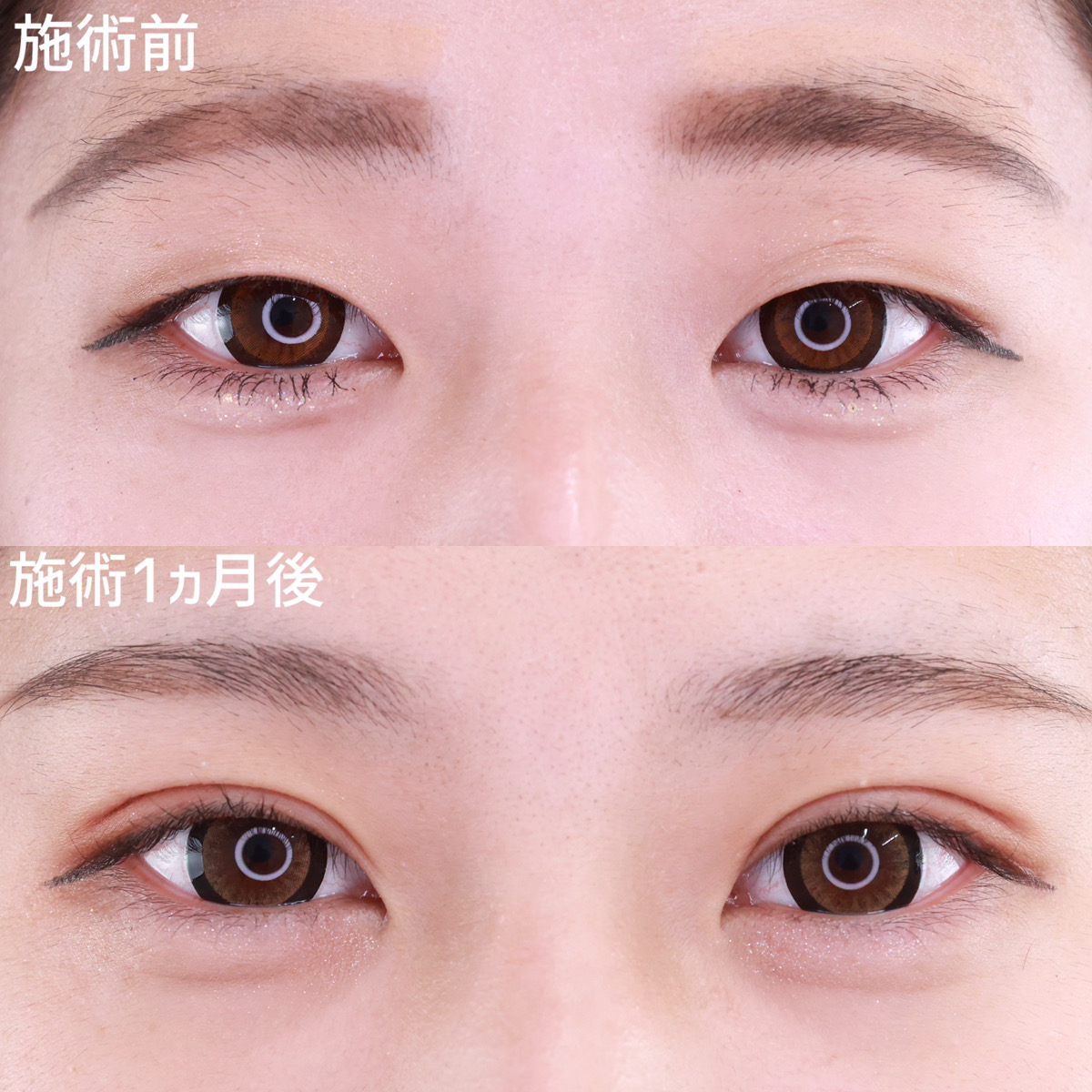 【二重切開】二重テープを卒業し半永久的な二重に！