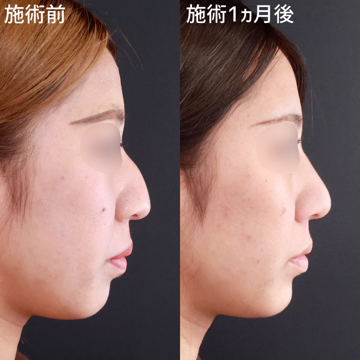 【わし鼻修正】ハンプ切除で綺麗な鼻筋に