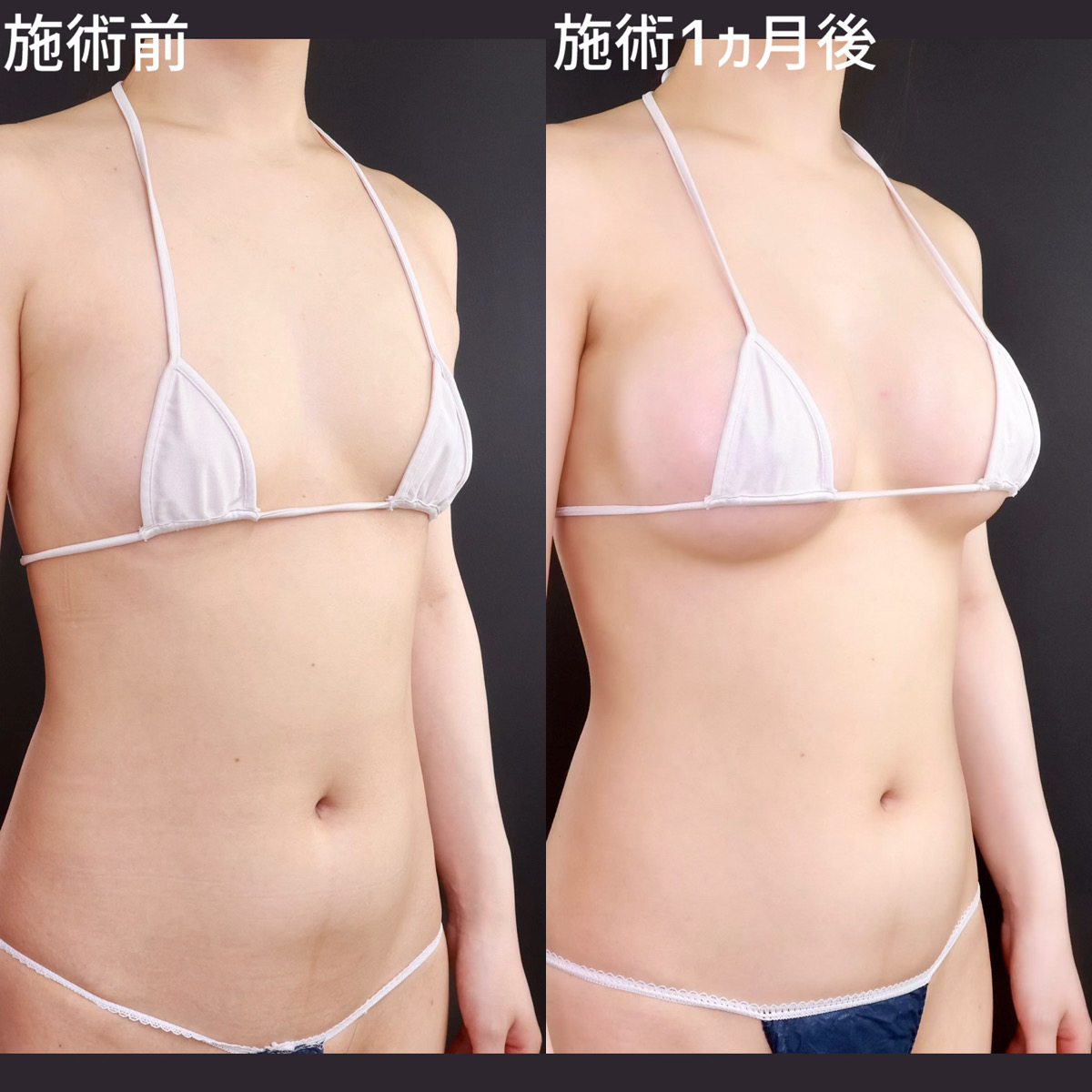 シリコンバッグ豊胸（人工乳腺バッグ）の症例写真 施術前後 