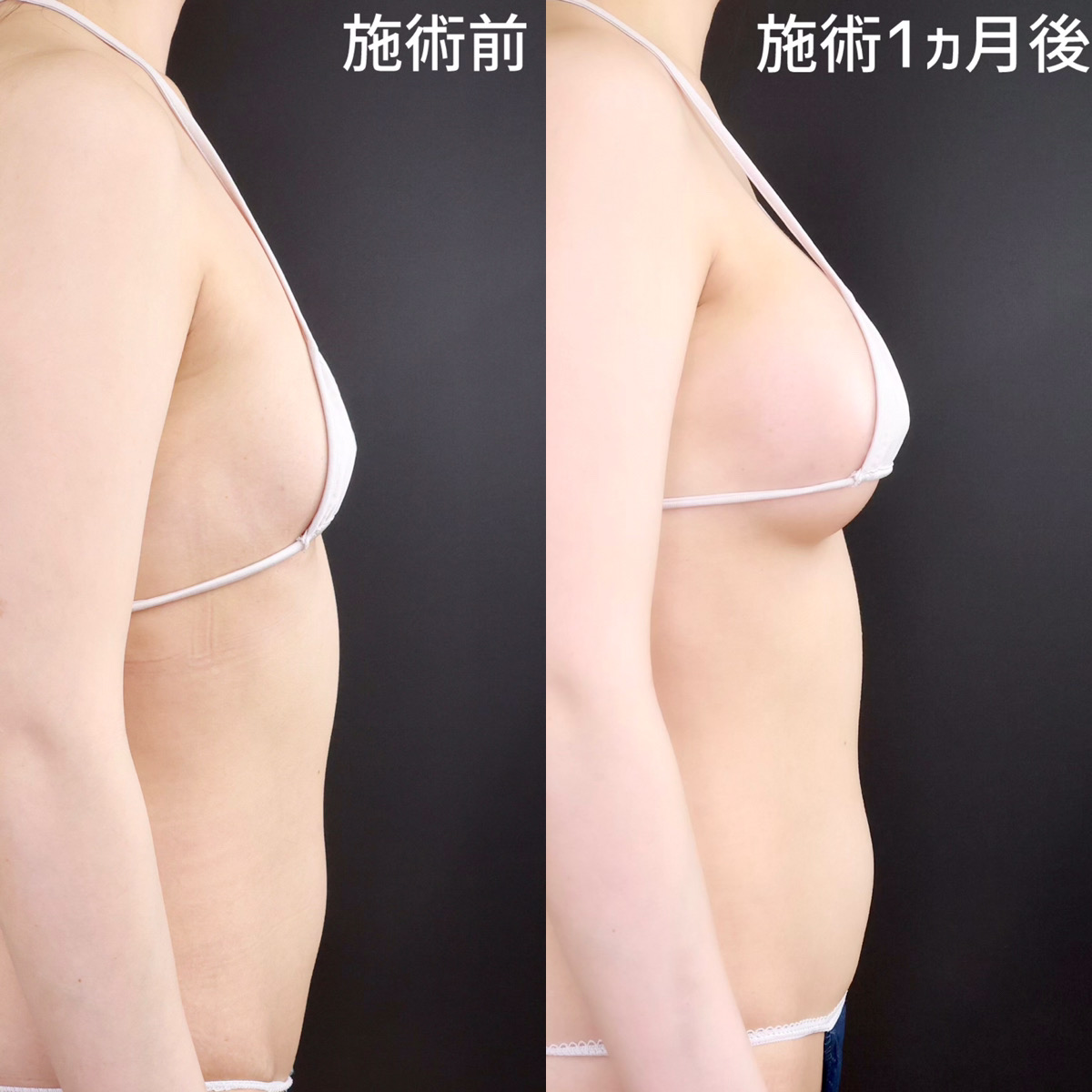 シリコンバッグ豊胸（人工乳腺バッグ）の症例写真 施術前後 