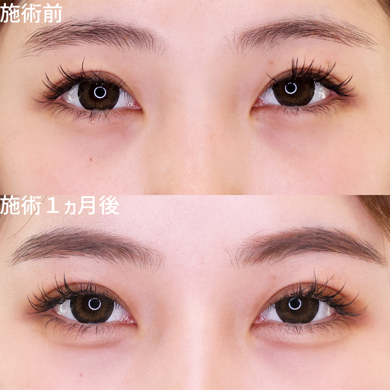 今っぽ幅広二重で可愛さアップ♡ 垢抜け二重埋没