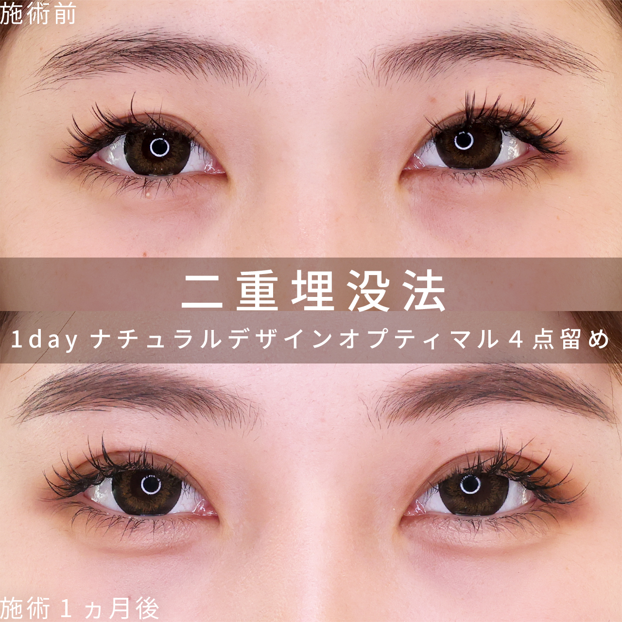 二重埋没法の症例写真 施術前後