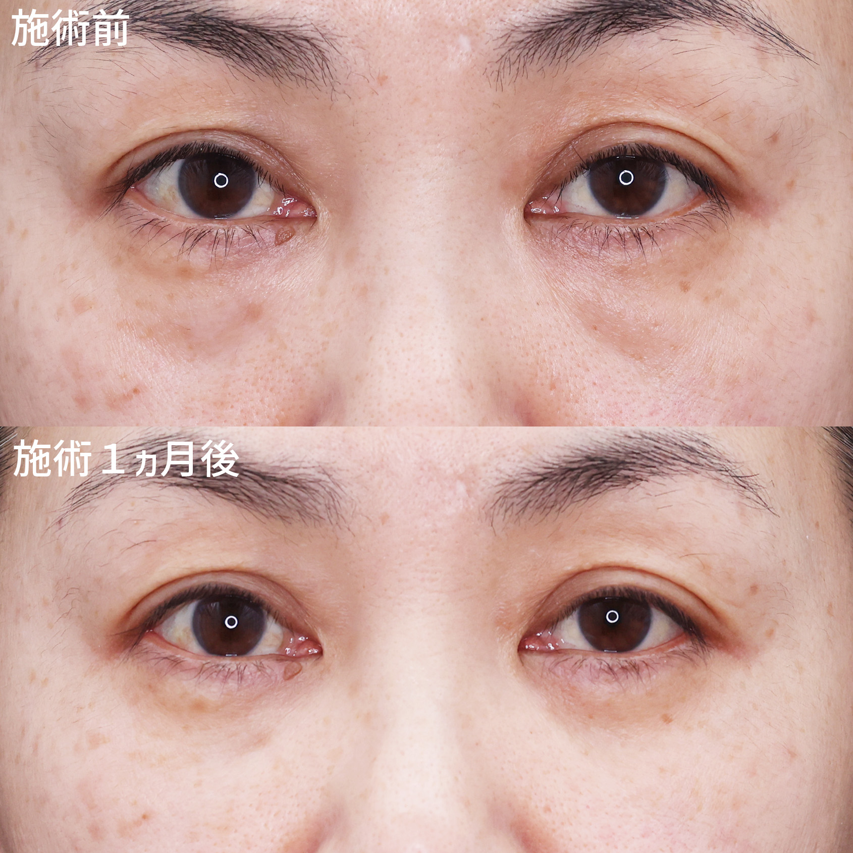 黒クマ改善で自然に若返り