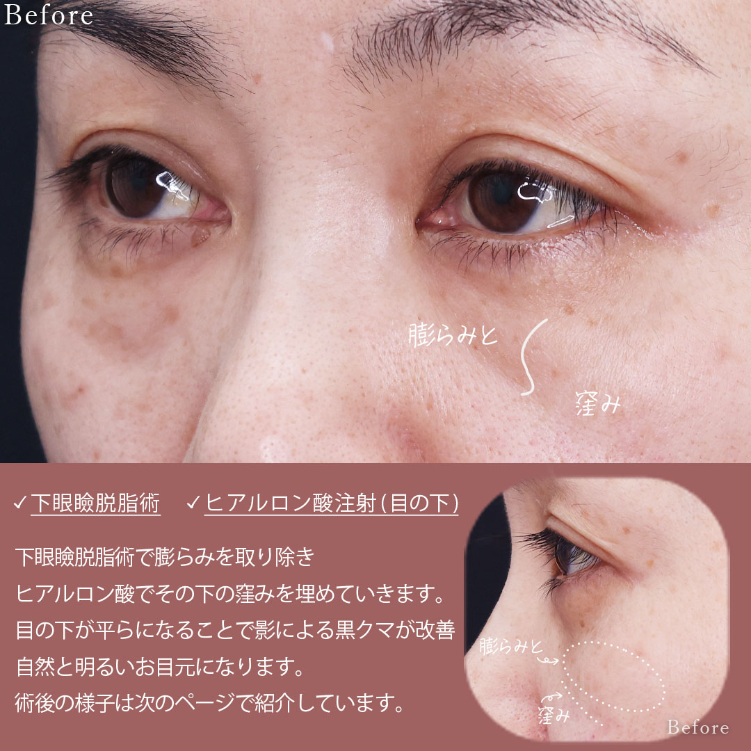 下眼瞼脱脂術（目の下のたるみ取り・目の下の脂肪ふくらみ取り）/目の下のヒアルロン酸注射の症例写真 施術前後 