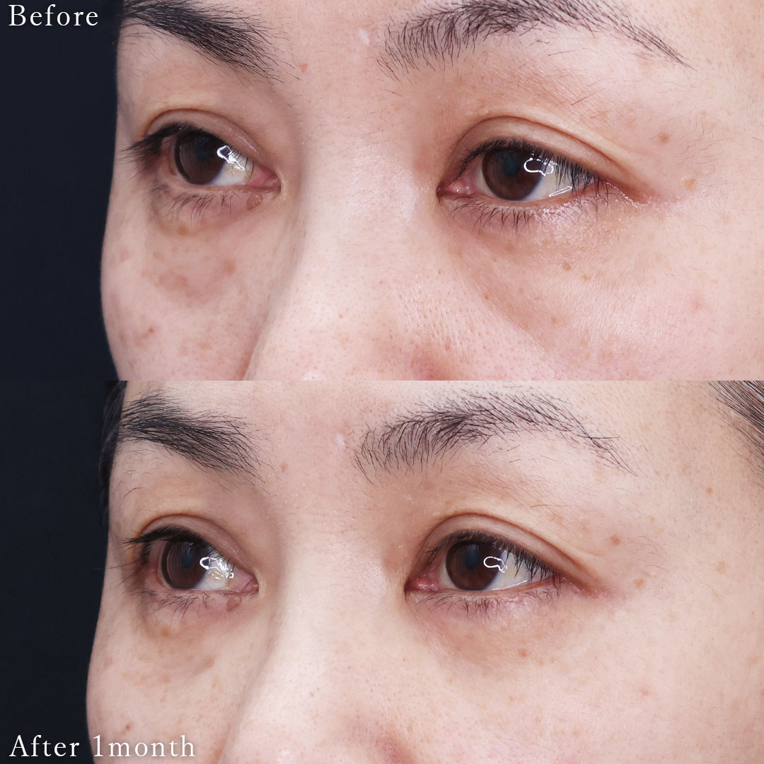 下眼瞼脱脂術（目の下のたるみ取り・目の下の脂肪ふくらみ取り）/目の下のヒアルロン酸注射の症例写真 施術前後 