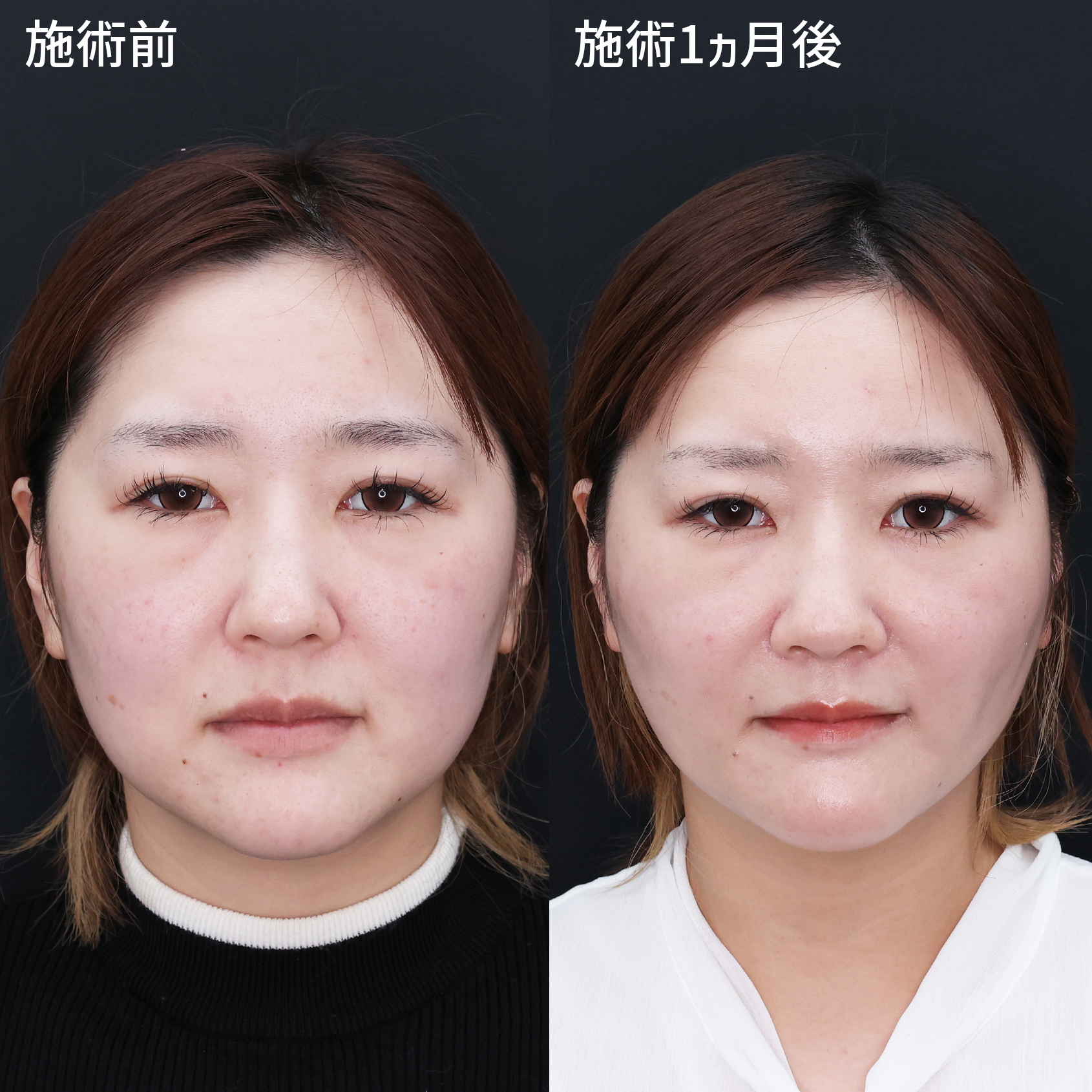 下膨れ型⇒卵型輪郭へ【糸リフト×脂肪除去】で垢抜け！