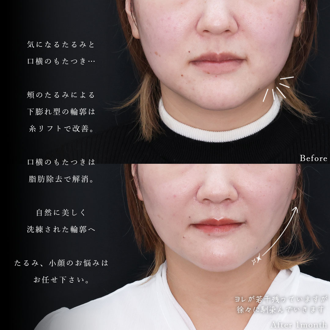 ジョールファット除去/TAC式 ツヤ肌コラーゲンリフト®/ヒアルロン酸注射:その他の症例写真 施術前後
