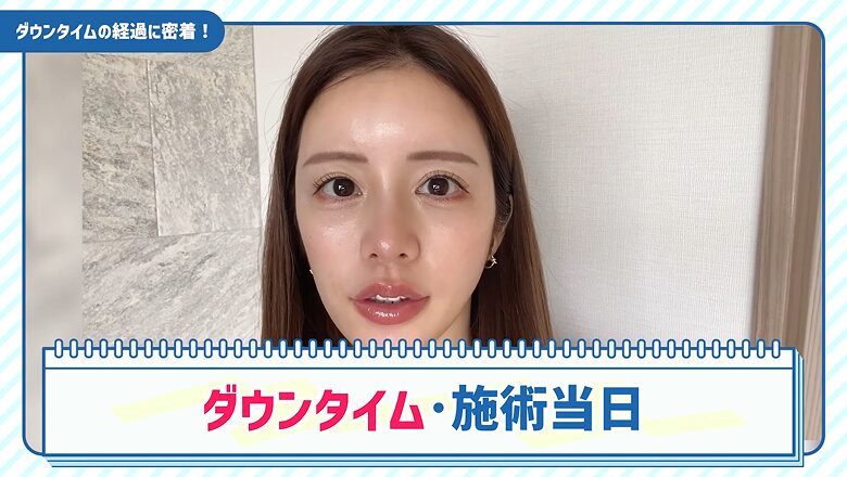 糸リフト施術当日のダウンタイムの様子