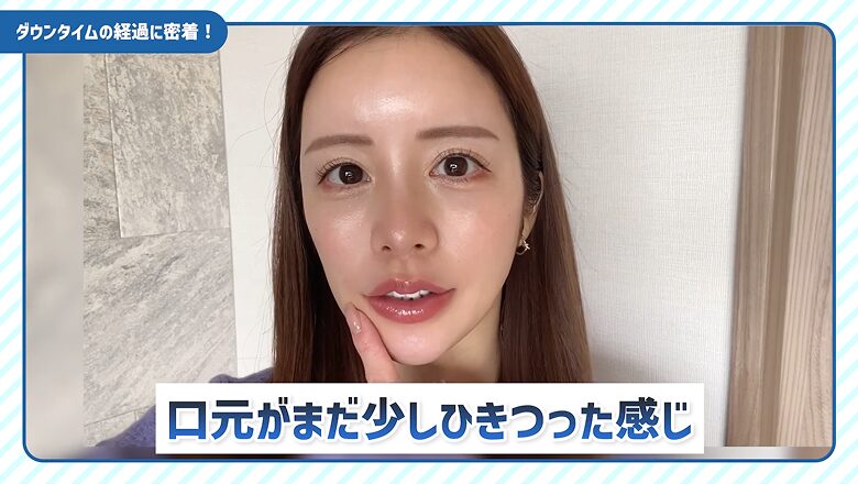 施術当日の口元のわずかなひきつれ感について話すRICOさん