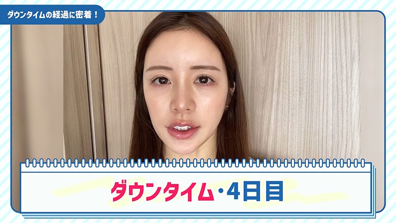 糸リフト施術から4日経過したダウンタイムの様子