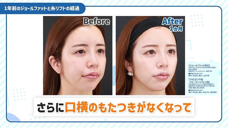 1年前のジョールファット除去と糸リフト1カ月後の比較写真